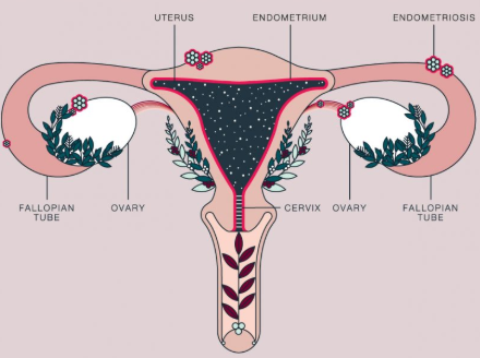 Endometriosis